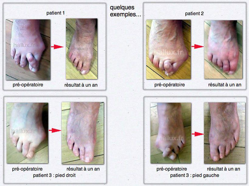 Chirurgie Mini invasive Et Percutan e Du Pied Et De La Cheville Et chirurgie-mini-invasive-et-percutan-e-du-pied-et-de-la-cheville-et